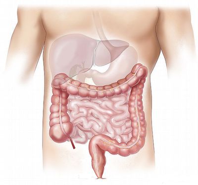 High incidence of bowel dysfunction